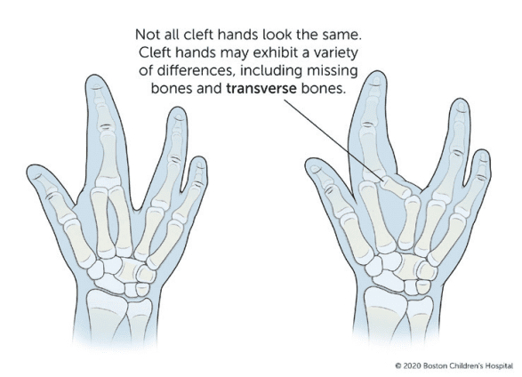 Hand Difference Cleft Hand – Reach